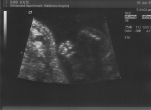 Week 20, scan 3  (sole of foot)